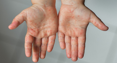 Bolest ruku, stopala i usta ( hand, foot and mouth disease) – Kardio medika – OGLASI PANTELEJ